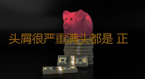 头屑很严重满头都是 正确洗护勤做头皮按摩缓解头屑